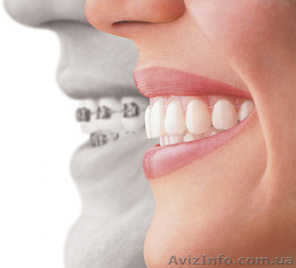 Врач-отродонт исправит неправильный прикус (Брекеты) - <ro>Изображение</ro><ru>Изображение</ru> #1, <ru>Объявление</ru> #164678