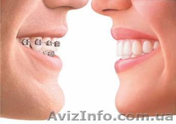 Брекеты фиксация за 2850 грн.*только до 01.10.2012! - <ro>Изображение</ro><ru>Изображение</ru> #1, <ru>Объявление</ru> #725958