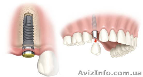 Установка имплантата! - <ro>Изображение</ro><ru>Изображение</ru> #1, <ru>Объявление</ru> #747284