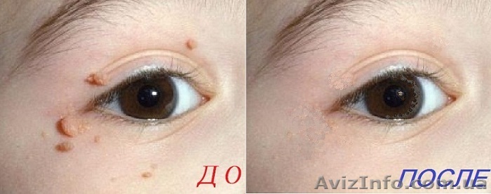 Удалить папилломы на лице без шрамов и боли - <ro>Изображение</ro><ru>Изображение</ru> #1, <ru>Объявление</ru> #1028588