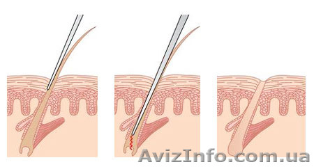 Электроэпиляция - <ro>Изображение</ro><ru>Изображение</ru> #1, <ru>Объявление</ru> #1169820
