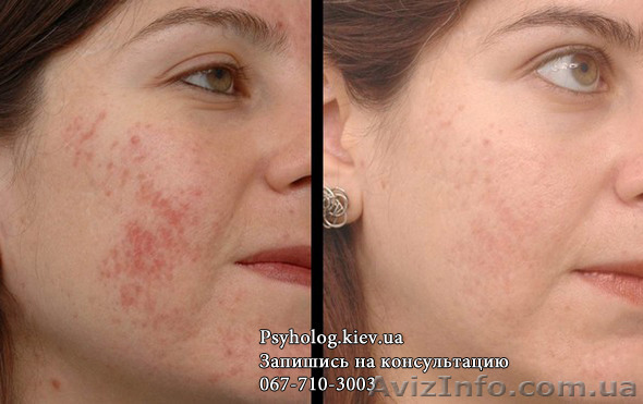 Помогу избавиться от аллергии - <ro>Изображение</ro><ru>Изображение</ru> #1, <ru>Объявление</ru> #1368036