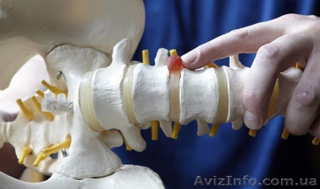 Лечение грыжи поясничного отдела позвоночника без операции. - <ro>Изображение</ro><ru>Изображение</ru> #1, <ru>Объявление</ru> #1636450