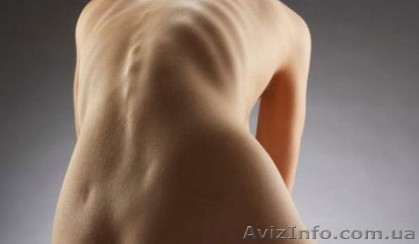 Сколиоз лечение.Проблема не пройдет сама собой! - <ro>Изображение</ro><ru>Изображение</ru> #1, <ru>Объявление</ru> #1636613