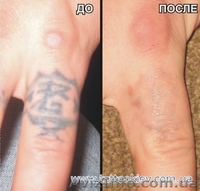 Удаление татуировки Киев фото до и после, вывести тату и татуаж Киев,  - <ro>Изображение</ro><ru>Изображение</ru> #1, <ru>Объявление</ru> #724821