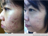 24 часа и ваша кожа сияет!Иначе мы вернем вам деньги - <ro>Изображение</ro><ru>Изображение</ru> #1, <ru>Объявление</ru> #898573