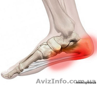 Пяточная шпора. Лечение и профилактика - <ro>Изображение</ro><ru>Изображение</ru> #3, <ru>Объявление</ru> #957220