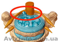 Лечение межпозвоночной грыжи без операции - <ro>Изображение</ro><ru>Изображение</ru> #1, <ru>Объявление</ru> #1177286