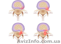 Лечение межпозвоночной грыжи без операции - <ro>Изображение</ro><ru>Изображение</ru> #3, <ru>Объявление</ru> #1177286