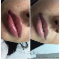 Увеличение, коррекция губ  - <ro>Изображение</ro><ru>Изображение</ru> #1, <ru>Объявление</ru> #1632127