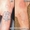 Удаление татуировки Киев фото до и после,  вывести тату и татуаж Киев,   #724821