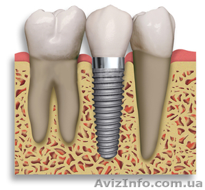 имплантация зубов в украине - <ro>Изображение</ro><ru>Изображение</ru> #1, <ru>Объявление</ru> #314826
