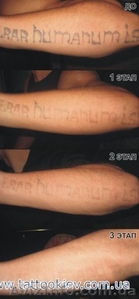 Удаление татуировки Киев фото до и после, вывести тату и татуаж Киев,  - <ro>Изображение</ro><ru>Изображение</ru> #3, <ru>Объявление</ru> #724821