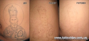 Удаление татуировки Киев фото до и после, вывести тату и татуаж Киев,  - <ro>Изображение</ro><ru>Изображение</ru> #4, <ru>Объявление</ru> #724821
