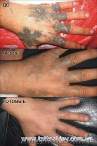 Удаление татуировки Киев фото до и после, вывести тату и татуаж Киев,  - <ro>Изображение</ro><ru>Изображение</ru> #5, <ru>Объявление</ru> #724821