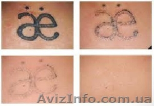 Удаление татуировок, татуажа, кремом Rejuvi Tattoo Remover - <ro>Изображение</ro><ru>Изображение</ru> #2, <ru>Объявление</ru> #1198986