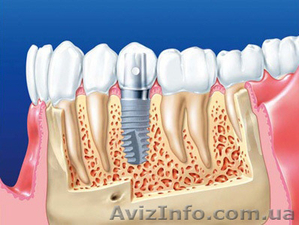 Имплантация зубов в Клинике эстетической стоматологии - <ro>Изображение</ro><ru>Изображение</ru> #1, <ru>Объявление</ru> #1229336