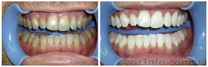 Профессиональное аппаратное отбеливание зубов Beyond - <ro>Изображение</ro><ru>Изображение</ru> #1, <ru>Объявление</ru> #1268547