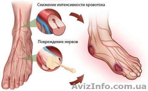 Cupron - носки для диабетиков! - <ro>Изображение</ro><ru>Изображение</ru> #1, <ru>Объявление</ru> #1504491