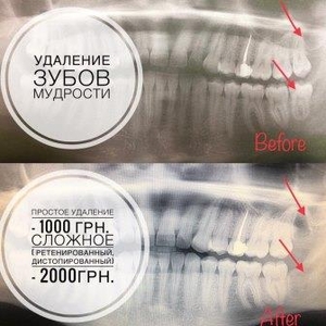 Удаление зубов мудрости - <ro>Изображение</ro><ru>Изображение</ru> #1, <ru>Объявление</ru> #1646879