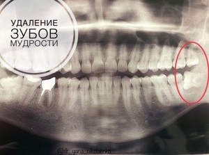 Удаление зубов мудрости - <ro>Изображение</ro><ru>Изображение</ru> #2, <ru>Объявление</ru> #1646879