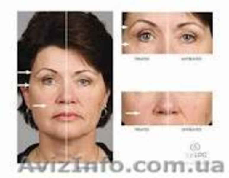 омоложение кожи лица и тела - <ro>Изображение</ro><ru>Изображение</ru> #1, <ru>Объявление</ru> #395833