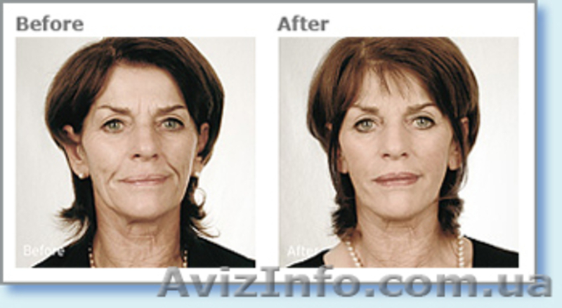 Контурная пластика в городе Киев - <ro>Изображение</ro><ru>Изображение</ru> #2, <ru>Объявление</ru> #549737