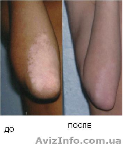 Лечение псориаза, витилиго, ожирения !!! - <ro>Изображение</ro><ru>Изображение</ru> #2, <ru>Объявление</ru> #522515