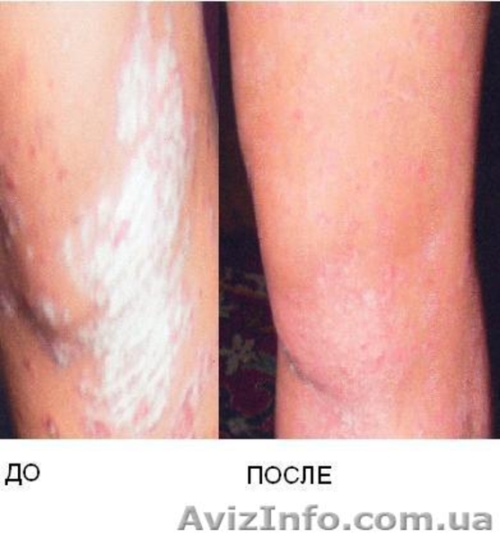 Лечение псориаза, витилиго, ожирения !!! - <ro>Изображение</ro><ru>Изображение</ru> #1, <ru>Объявление</ru> #522515
