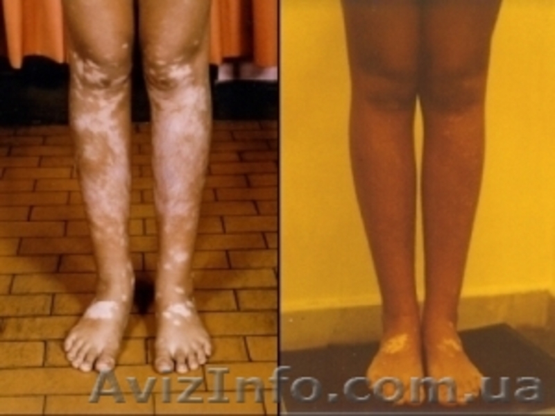 Средство от витилиго - <ro>Изображение</ro><ru>Изображение</ru> #2, <ru>Объявление</ru> #651388