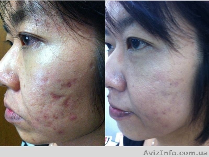 24 часа и ваша кожа сияет!Иначе мы вернем вам деньги - <ro>Изображение</ro><ru>Изображение</ru> #1, <ru>Объявление</ru> #898573