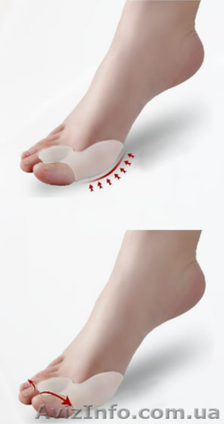 Фиксатор для коррекции деформированного большого пальца - <ro>Изображение</ro><ru>Изображение</ru> #3, <ru>Объявление</ru> #1124048