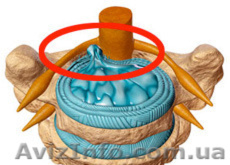 Лечение межпозвоночной грыжи без операции - <ro>Изображение</ro><ru>Изображение</ru> #1, <ru>Объявление</ru> #1177286