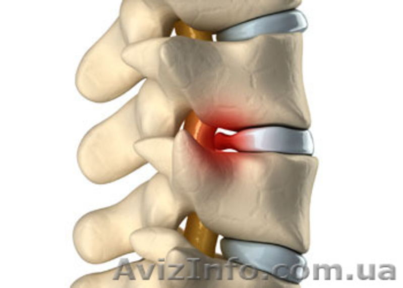 Лечение межпозвоночной грыжи без операции - <ro>Изображение</ro><ru>Изображение</ru> #2, <ru>Объявление</ru> #1177286