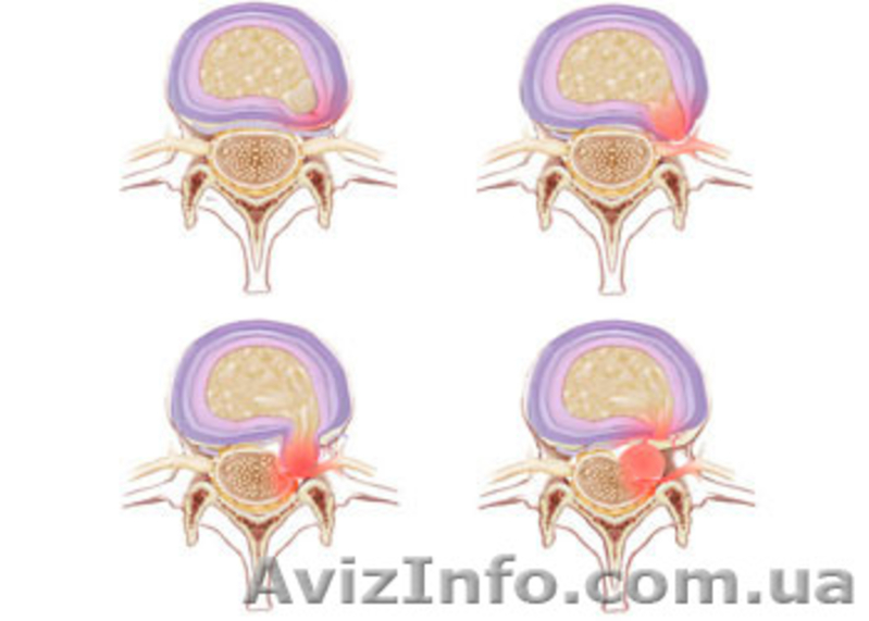 Лечение межпозвоночной грыжи без операции - <ro>Изображение</ro><ru>Изображение</ru> #3, <ru>Объявление</ru> #1177286