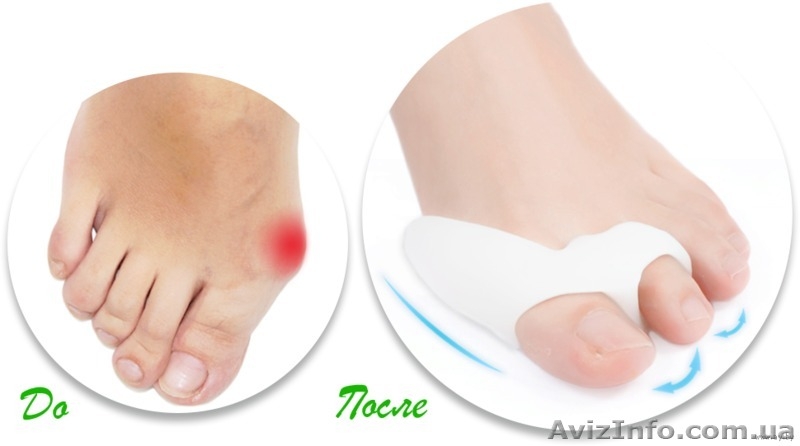 Супер цена!!! Успейте купить Valgus Pro!!!  - <ro>Изображение</ro><ru>Изображение</ru> #1, <ru>Объявление</ru> #1171178