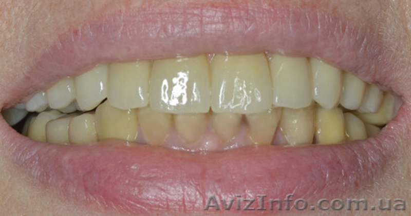 Имплантация при полной потере зубов - <ro>Изображение</ro><ru>Изображение</ru> #3, <ru>Объявление</ru> #1276285