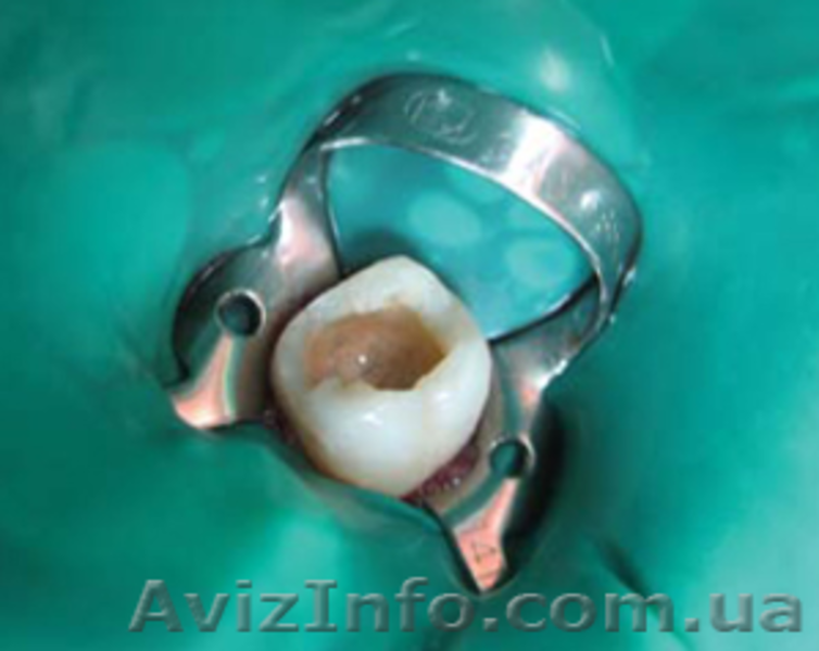 Эндодонтическое лечение зубов - <ro>Изображение</ro><ru>Изображение</ru> #2, <ru>Объявление</ru> #1312542