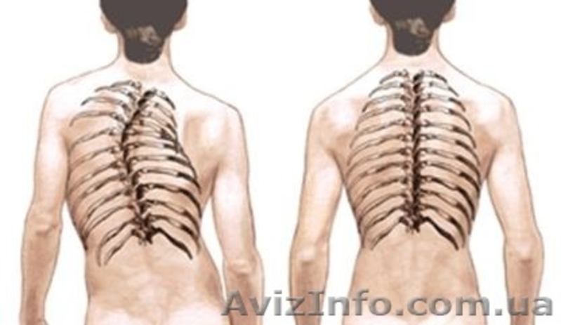 Исцеление от сколиоза, лордоза, кифоза, межпозвоночных грыж без упражнений - <ro>Изображение</ro><ru>Изображение</ru> #3, <ru>Объявление</ru> #1622350