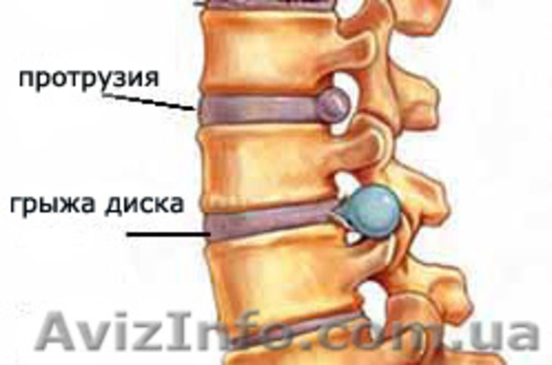 Исцеление от сколиоза, лордоза, кифоза, межпозвоночных грыж без упражнений - <ro>Изображение</ro><ru>Изображение</ru> #4, <ru>Объявление</ru> #1622350