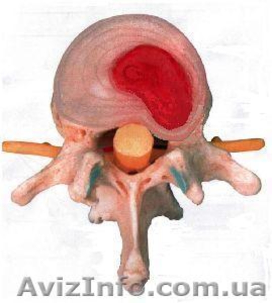 Исцеление от сколиоза, лордоза, кифоза, межпозвоночных грыж без упражнений - <ro>Изображение</ro><ru>Изображение</ru> #5, <ru>Объявление</ru> #1622350