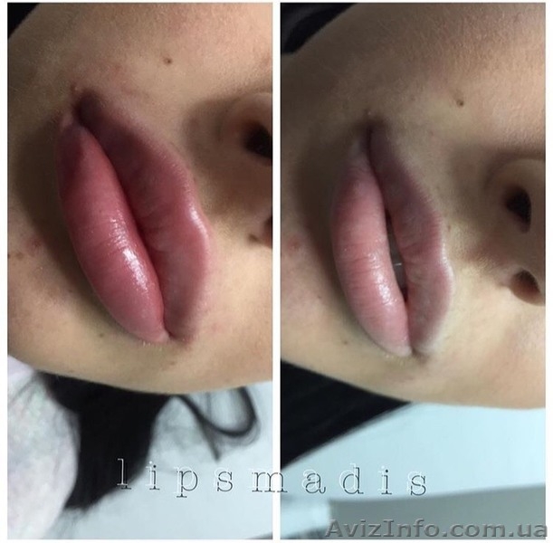 Увеличение, коррекция губ  - <ro>Изображение</ro><ru>Изображение</ru> #1, <ru>Объявление</ru> #1632127