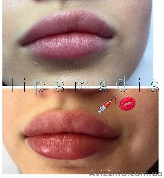 Увеличение, коррекция губ  - <ro>Изображение</ro><ru>Изображение</ru> #2, <ru>Объявление</ru> #1632127