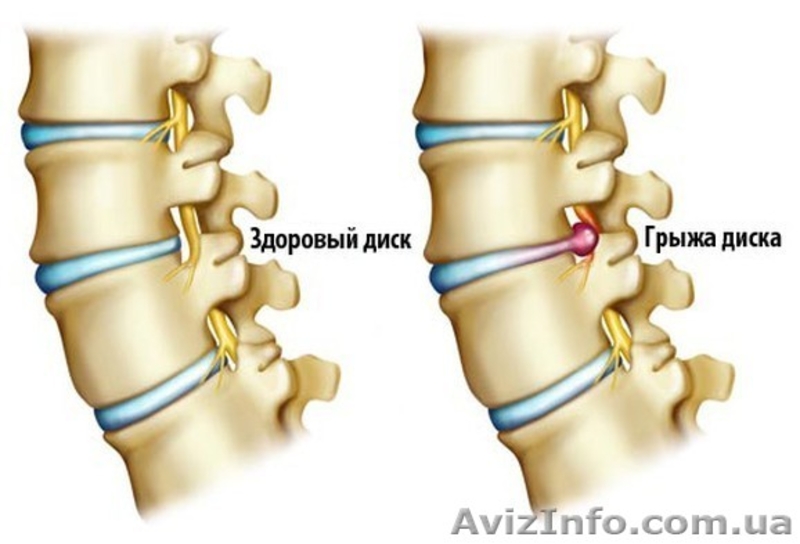 Как лечить грыжу поясничного отдела . - <ro>Изображение</ro><ru>Изображение</ru> #3, <ru>Объявление</ru> #1636435